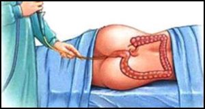 Read more about the article बस्ति (Vasti / Enema)