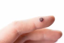 Read more about the article चामखीळ (Wart)