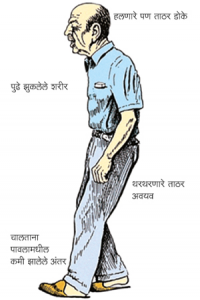 Read more about the article कंपवात (Parkinson’s disease)