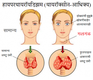 Read more about the article गलगंड (Goitre)