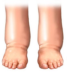 Read more about the article जलोदर (Ascites)