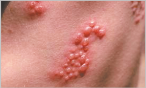 Read more about the article नागीण (Herpes zoster)