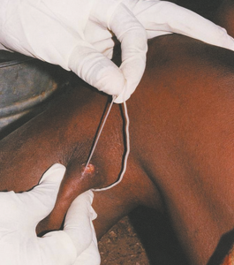 Read more about the article नारू (Dracunculiasis)
