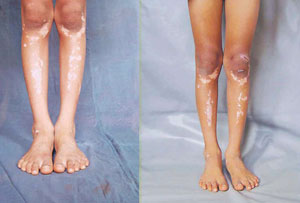 Read more about the article कोड (Vitiligo)