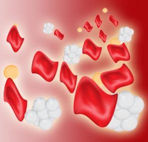 Read more about the article थॅलॅसेमिया (Thalassemia)