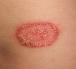 नायटा (Ringworm)