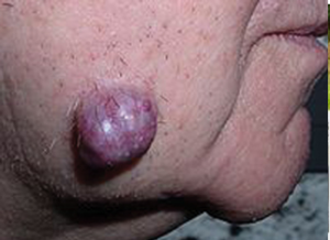 अर्बुद (Tumour)