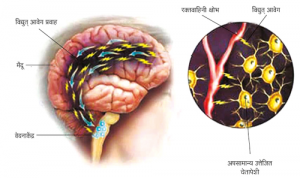 अर्धशिशी (Migraine)