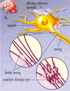 अल्झायमर विकार (Alzheimer disease)