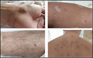 कांजिण्या (Chickenpox/Varicella)