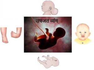 उपजत व्यंग (Congenital Anomalies)