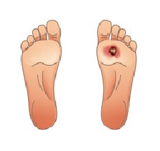 कोथ (Gangrene)