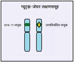 Read more about the article प्यूट्झ-जेघर लक्षणसमूह  (Peutz-Jegher’s Syndrome, PJS)
