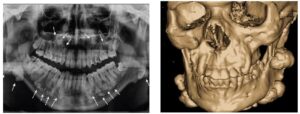 गार्डनर लक्षणसमूह  (Gardner’s syndrome)