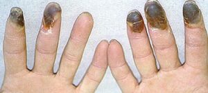 ब्यूर्गर रोग (Buerger’s disease/Thromboangiitis Obliterans)