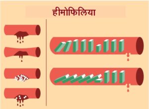 हीमोफिलिया/रक्तस्रावी रोग (Hemophilia)