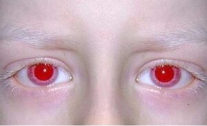 Read more about the article विवर्णता (Albinism)