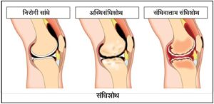 Read more about the article संधिशोथ (Arthritis)