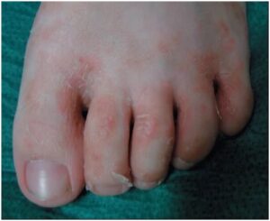 Read more about the article बुरशीजन्य व्याधी (कवकसंसर्ग रोग; Fungal Disease)
