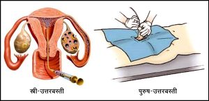 उत्तरबस्ती (Uttarbasti)
