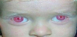वर्णहीनता (Albinism)