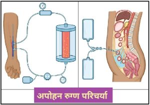 अपोहन रुग्ण परिचर्या (Dialysis Patient Nursing)