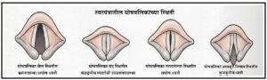 घोषत्व (Voicing)